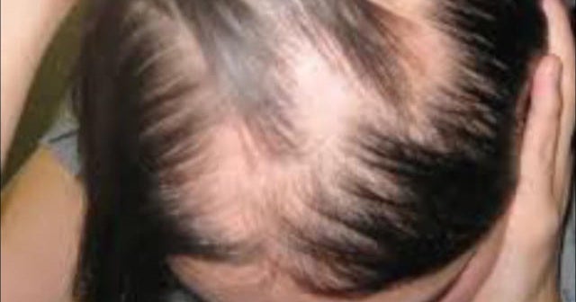 Drug shows promise for hair loss condition