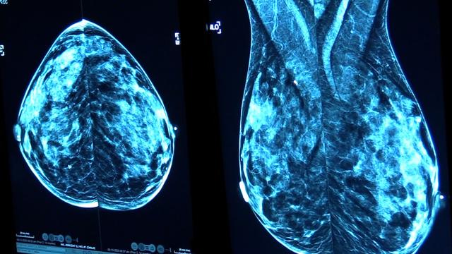 cbsn-fusion-doctors-are-finding-that-covid-vaccines-are-messing-with-mammogram-results-causing-false-red-flags-in-the-cancer-screening-thumbnail-719462-640x360.jpg 
