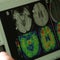 COVID-19 study sees significant impact on brain