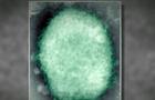 cbsn-fusion-man-hospitalized-with-monkeypox-in-massachusetts-thumbnail-1020046-640x360.jpg 