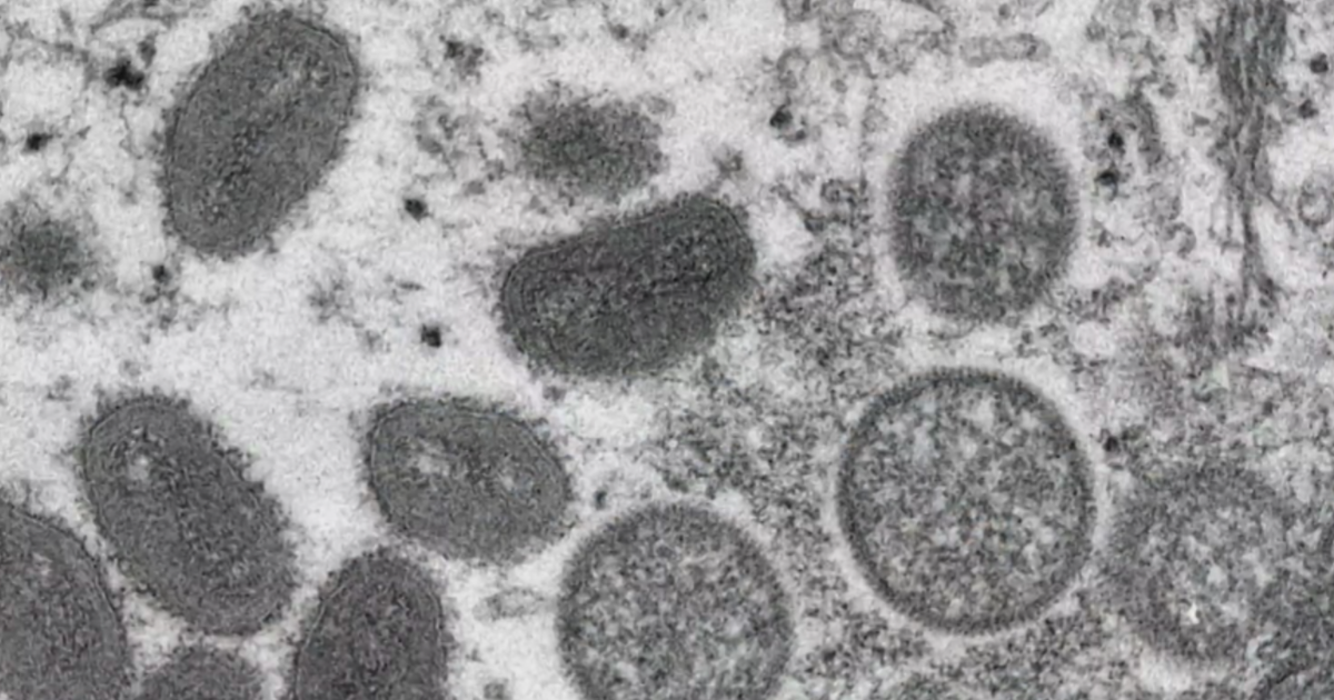 Monkeypox patient in Boston had contact with 200 people, CDC says