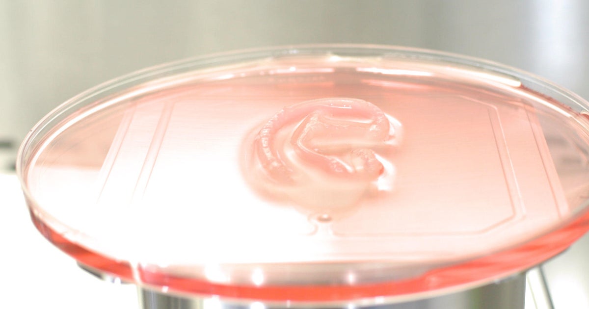 Woman gets 3D printed ear transplant made of her own cells - Vimarsana News